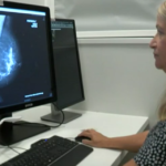 Artificial intelligence software is supporting breast cancer screening at ULHT