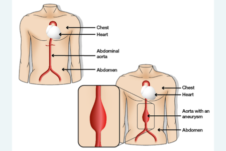 Abdominal Aortic Aneurysm (AAA)