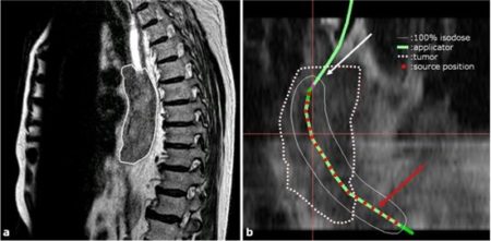 Brachytherapy