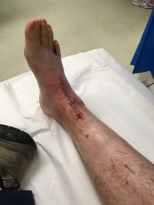 Ankle operations