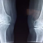 X-Ray of a knee
