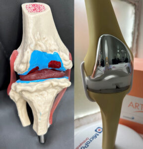 knee replacement joint model and artificial knee