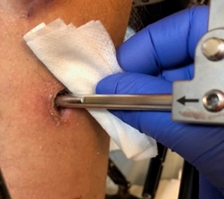 Step 5 Clean each pin site individually. Wipe around each pin site with the wet cotton bud or wet piece of gauze in a circular motion.