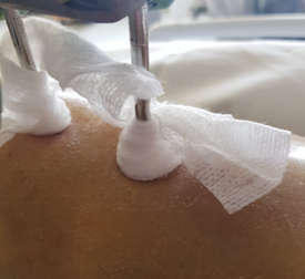 Step 7 To begin with, each pin site will need to be dressed with gauze. You will be taught how to do this before leaving the hospital. Your consultant or their team will advise you when your pin sites do not need to be dressed anymore.