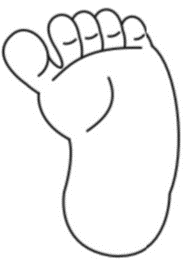 Figure 2. Metatarsus adductus 